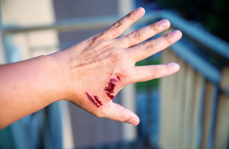 Close-up of a left hand with fresh, bleeding cuts on the back, against a blurred outdoor background.
